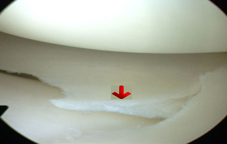 Menisco sano medial en rodilla derecha - Dr. Aldo Bauza especialista en cirugía de rodilla